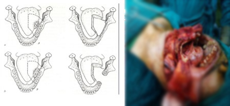 Jaw Bone Cancer Treatment